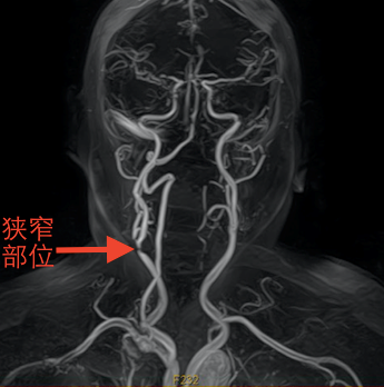 图一：术前颈部MRA.png