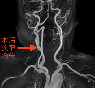 图三：术后复查的颈部MRA.png